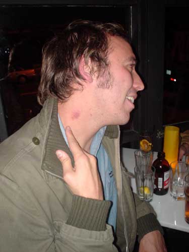hickey