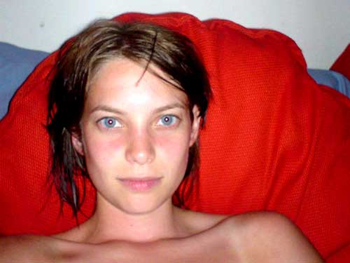 sunburn