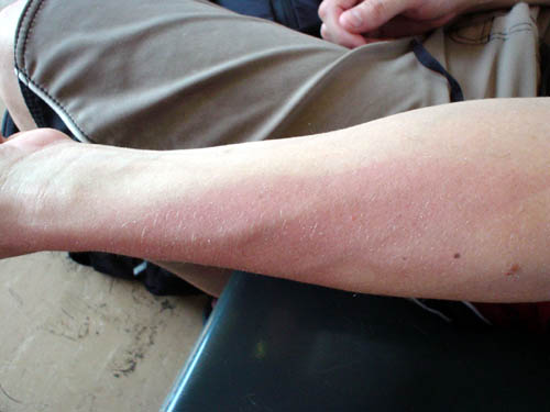 sunburn