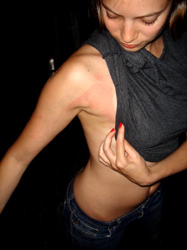 sunburn