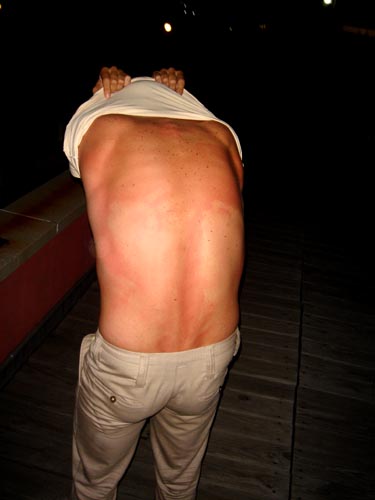 sunburn