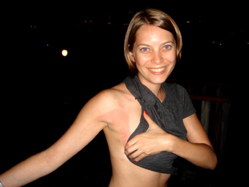 sunburn