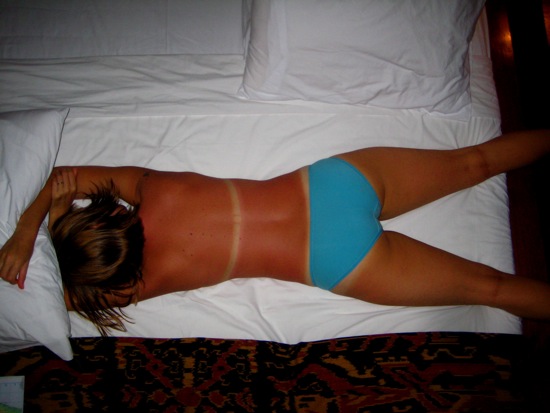 sunburn