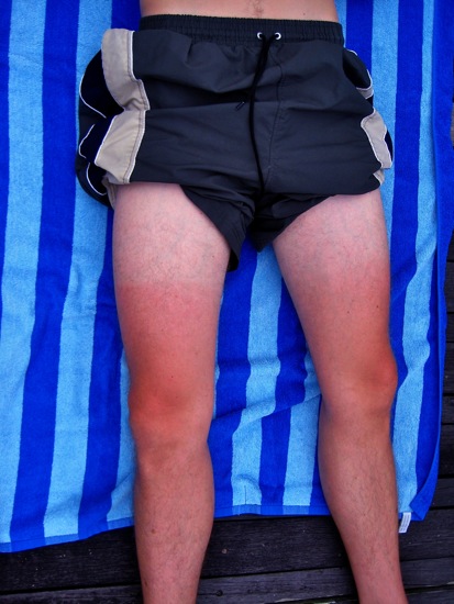 sunburn