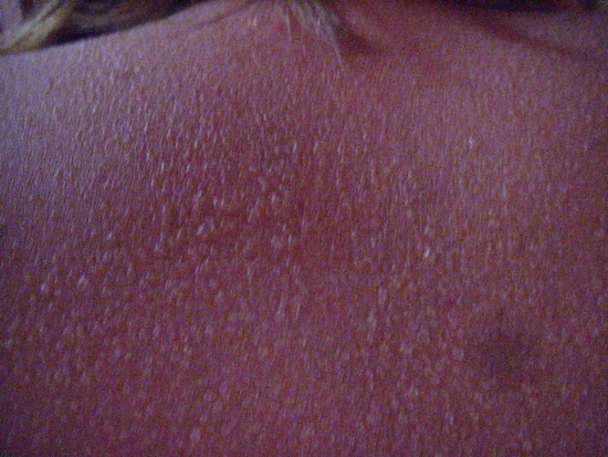 sunburn