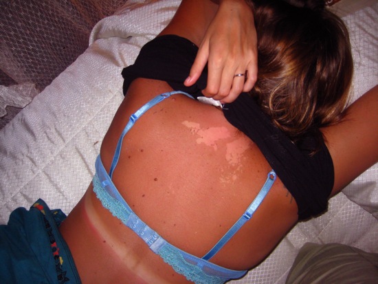 sunburn