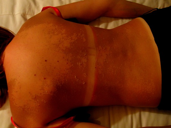 sunburn