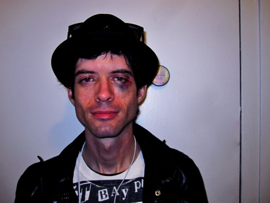 black eye