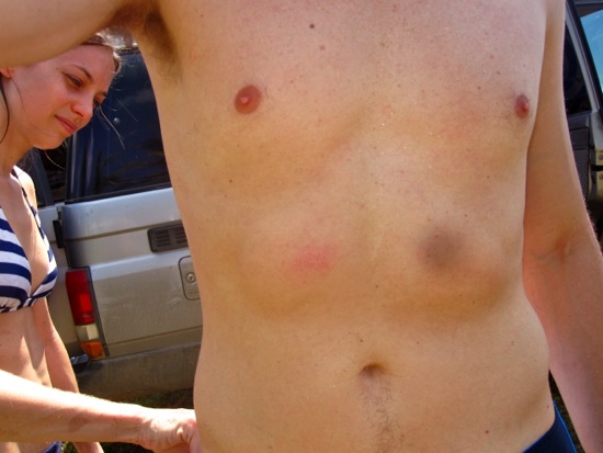 bruise